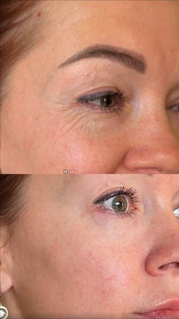 Морщины исчезли за 1 минуту 😱