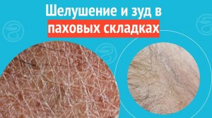 🙁 Шелушение и зуд в паховых складках. Клинический случай №1263