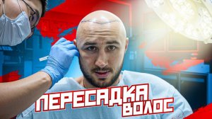 ПЕРЕСАДКА ВОЛОС ТИМУРУ НИКУЛИНУ