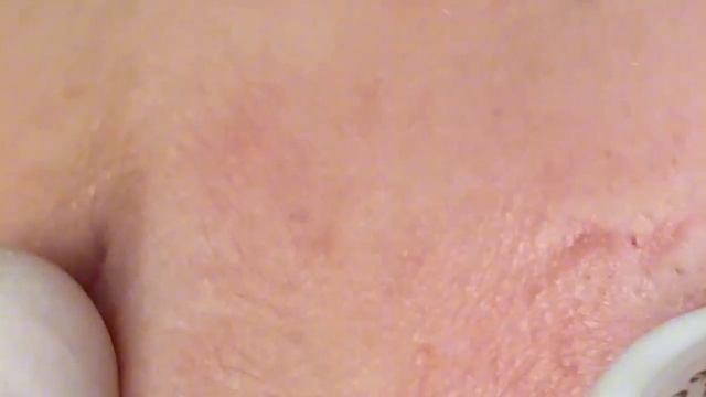 Выдавливание прыщей, угрей, черных точек и камедонов #378