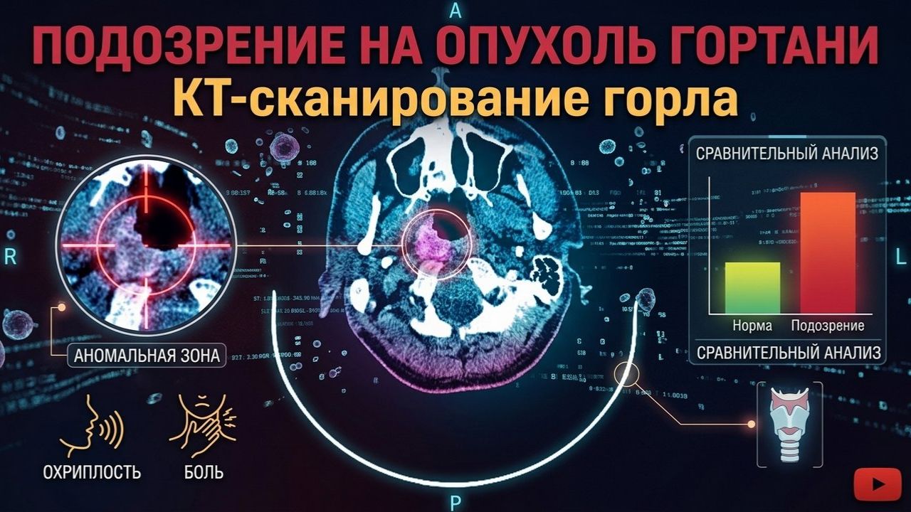 Подозрение на ОПУХОЛЬ ГОРТАНИ образования в язычно-надгортанном углублении на РАСШИФРОВКЕ КТ гортани