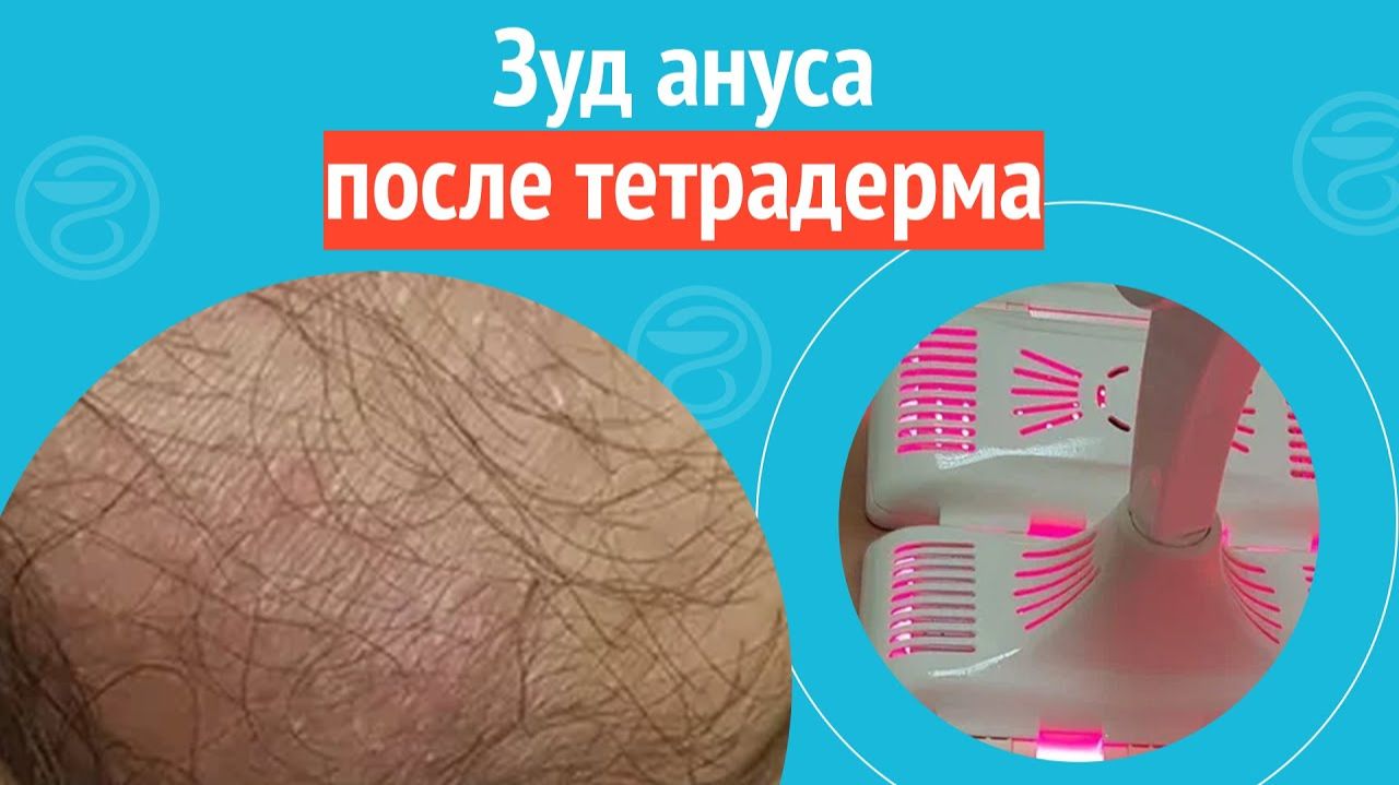 👉 Зуд ануса после тетрадерма. Клинический случай №1266