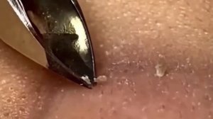 #282 Чистка лица от угрей и акне. Выдавливание прыщей. Удаление черных точек и комедонов