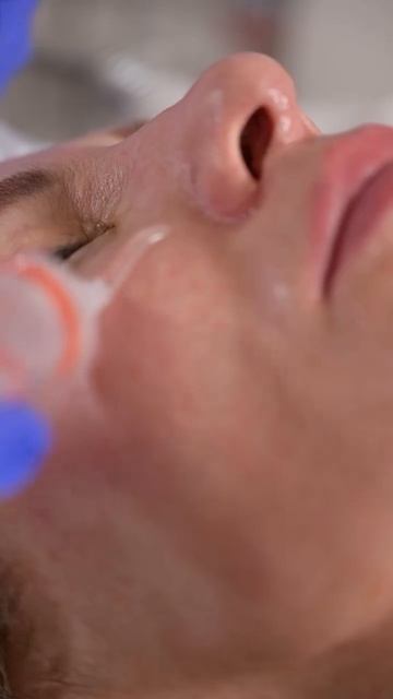 Монополярный RF — это не про «подтянуть здесь и сейчас».