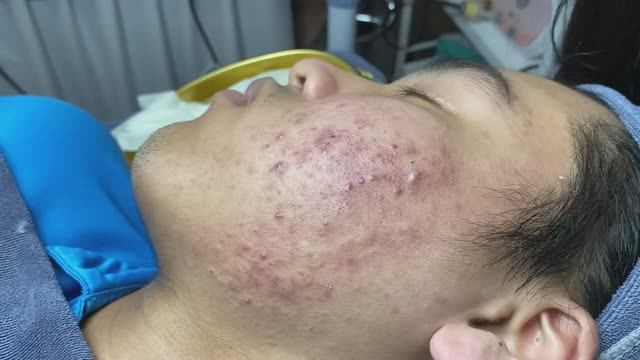 Удаление открытых и закрытых комедонов на щеках