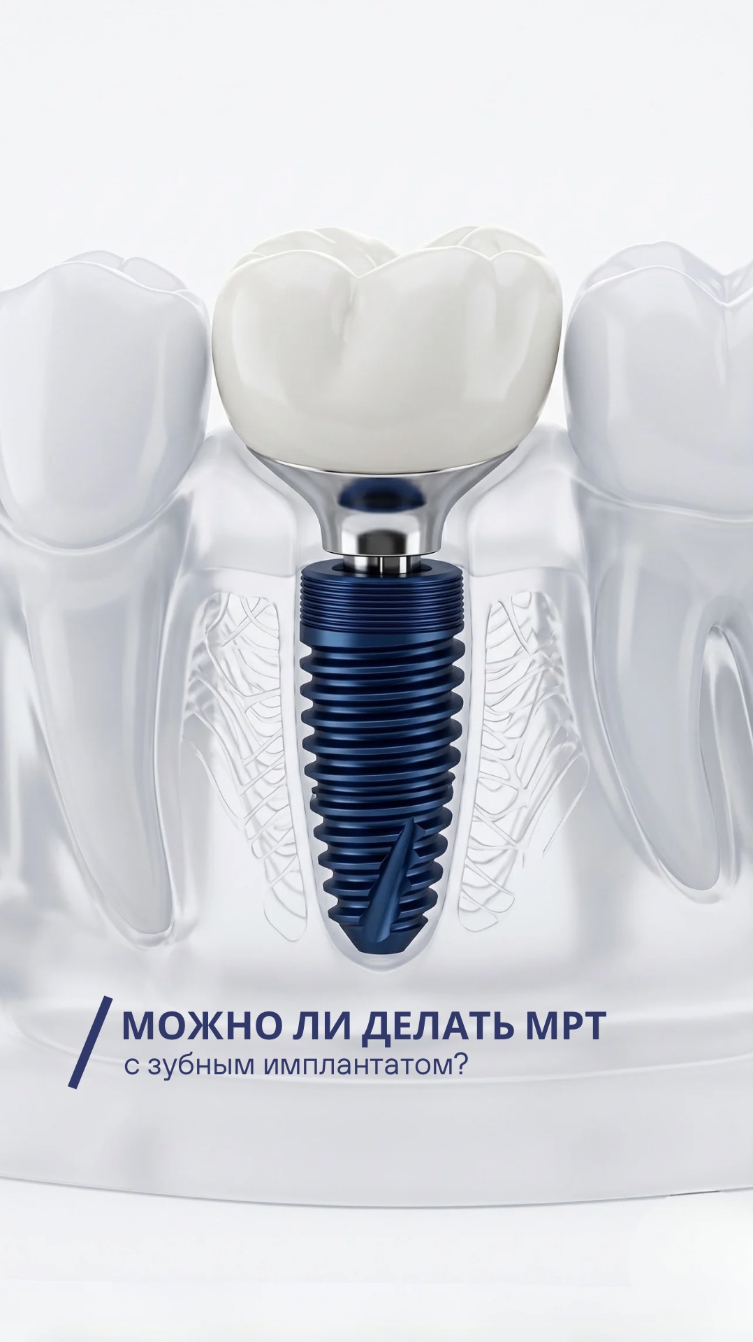 🦷А можно ли проводить МРТ с имплантатами и коронками?