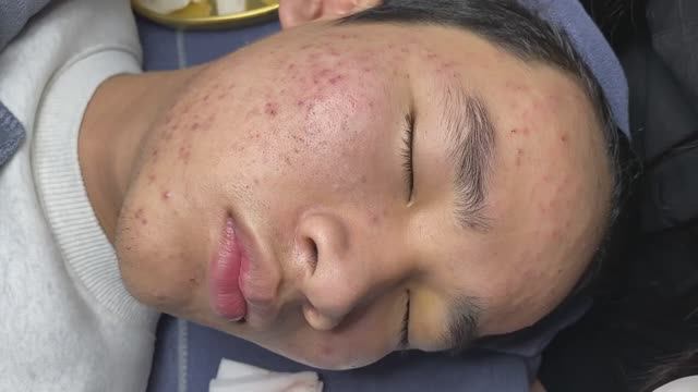 Удаление комедонов. Процесс чистки лица