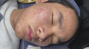 Удаление комедонов. Процесс чистки лица