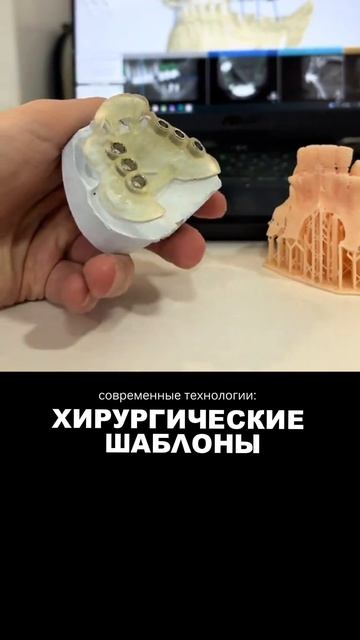 Мифы об имплантации