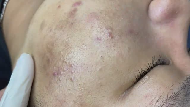 093 • Acne Collection • АСМР • Relax Spa