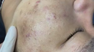 093 • Acne collection • АСМР • Relax Spa