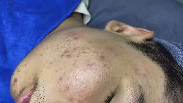 095 • Acne Collection • АСМР • Relax Spa