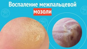 🦶 Воспаление межпальцевой мозоли. Клинический случай №1250