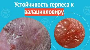 ? Устойчивость герпеса к валацикловиру. Клинический случай №1184