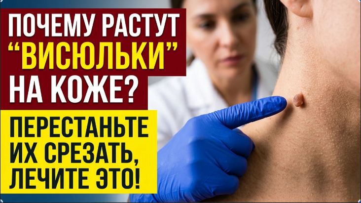 ПАПИЛЛОМЫ на Шее Это Главный Признак Скрытого Диабета
