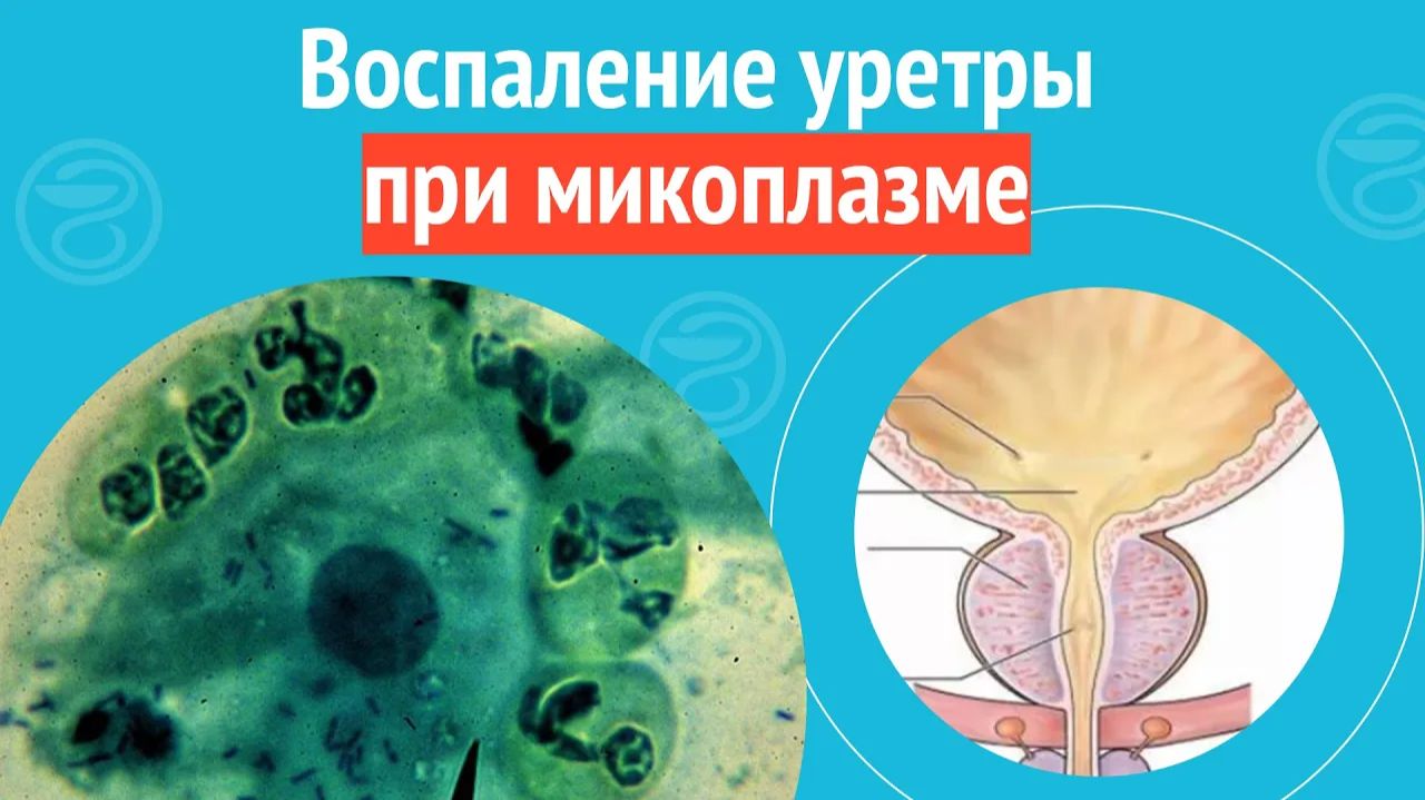 👉 Воспаление уретры при микоплазме. Клинический случай №1261 смотреть онлайн