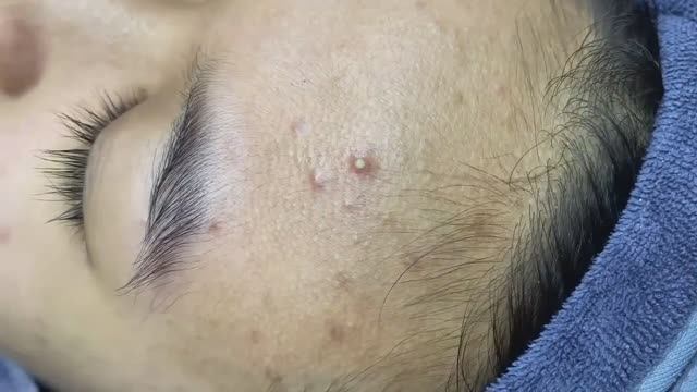 096 • Acne Collection • АСМР • Relax Spa