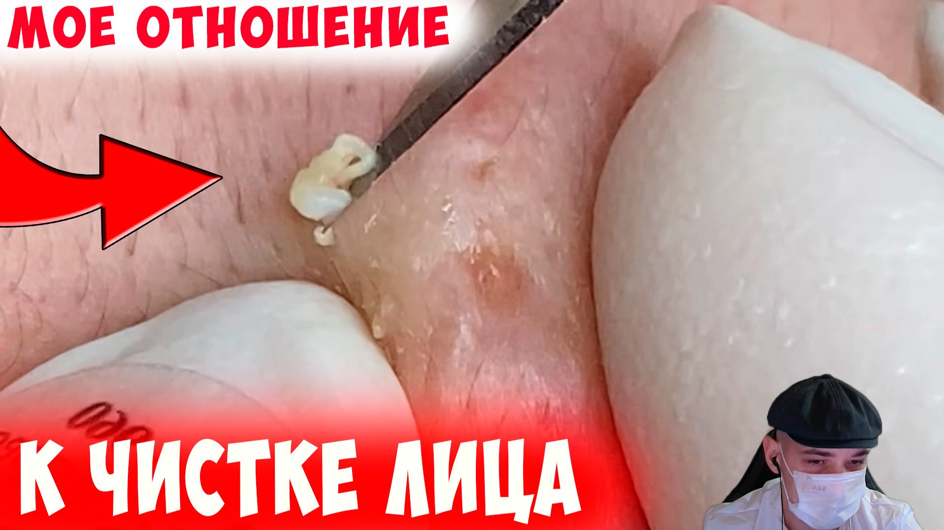 Мое Отношение к Чисткам Лица + Свой Опыт Лечения Акне