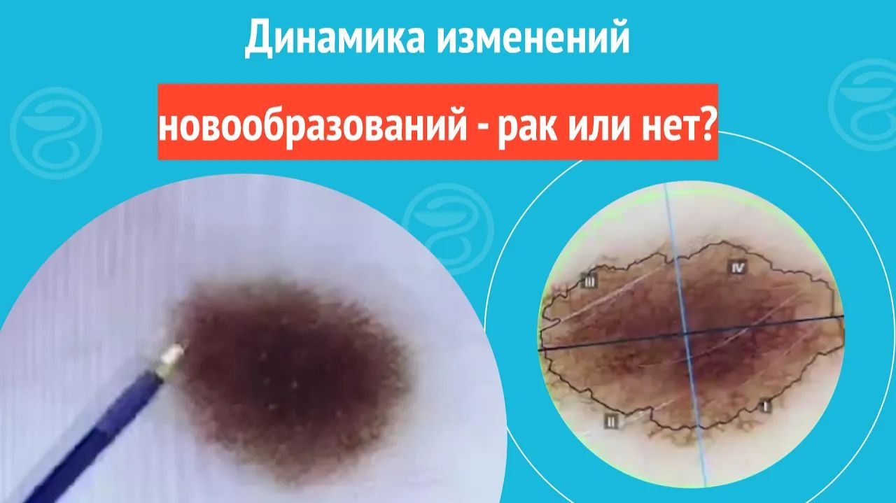 Динамика изменений новообразований - рак или нет? смотреть онлайн