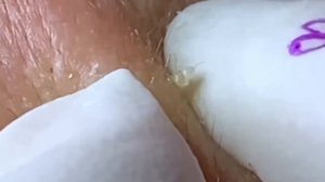 #283 Чистка лица от угрей и акне. Выдавливание прыщей. Удаление черных точек и комедонов