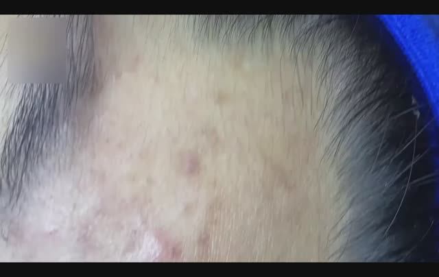 Удаление стеатоцистов на руке и акне на лице.