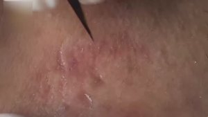 Полное удаление черных точек и акне