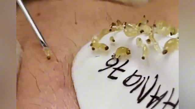 Выдавливание прыщей, угрей, черных точек и камедонов #382