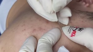 094 • Acne collection • АСМР • Relax Spa