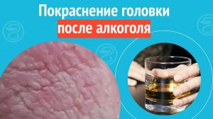 🍺 Покраснение головки после алкоголя. Клинический случай №1243