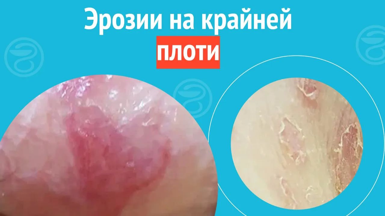 😦Эрозии на крайней плоти. Клинический случай №1256