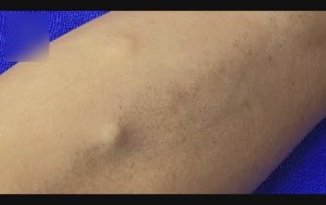 Удаление стеатоцистов на руке и акне на лице.