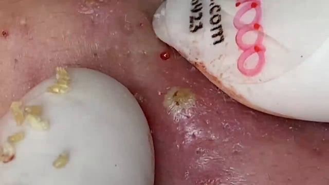 089 • Acne collection • АСМР • Relax Spa