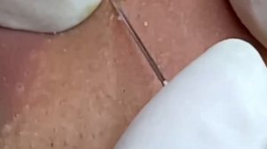 #285 Чистка лица от угрей и акне. Выдавливание прыщей. Удаление черных точек и комедонов