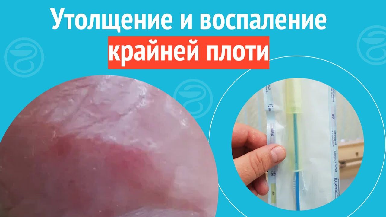 😦 Утолщение и воспаление крайней плоти. Клинический случай №1260 смотреть онлайн