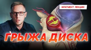 Жуткий прострел в спине! Как остановить формирование грыжи