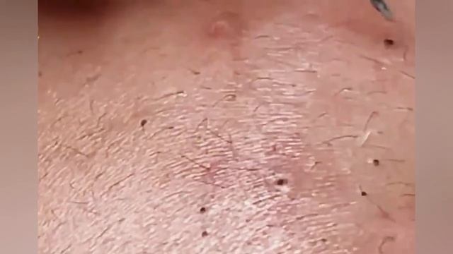 Выдавливание прыщей, угрей, черных точек и камедонов #381