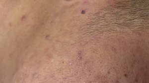 Чистим кожу от акне. Расслаблющее видео