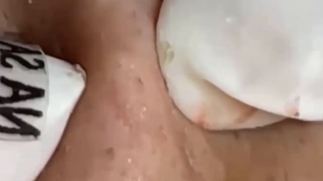 #286 Чистка лица от угрей и акне. Выдавливание прыщей. Удаление черных точек и комедонов