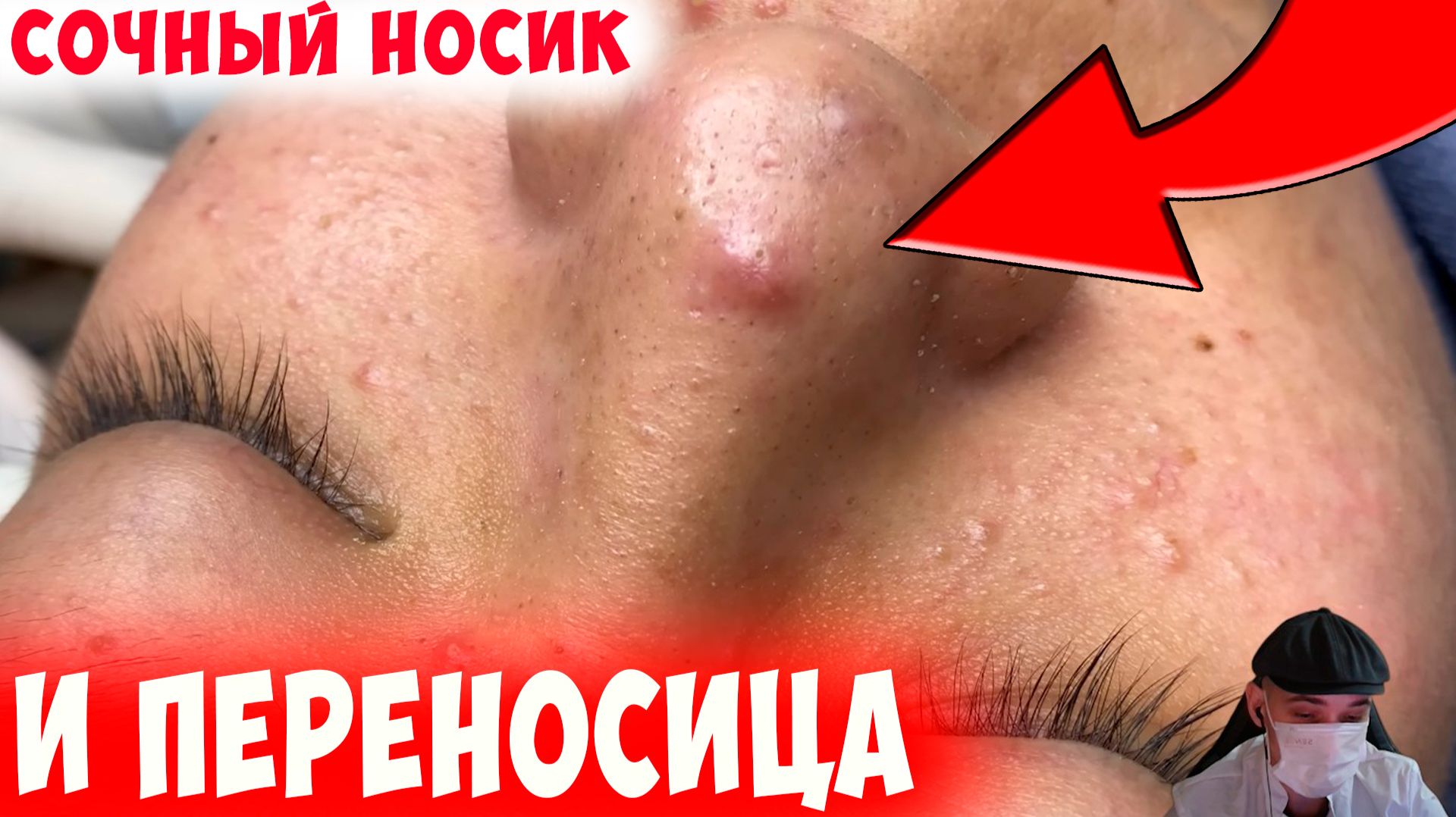 Сочный Нос и Переносица - У меня Было Даже Хуже!