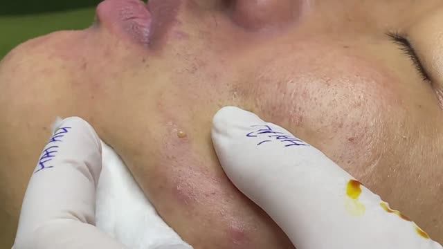 Акне вызванное воспалением сальных желез