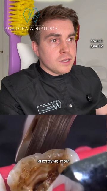 Как вы думаете, что проще стоматологу, удалить разрушенный зуб с кистой или лечить его?