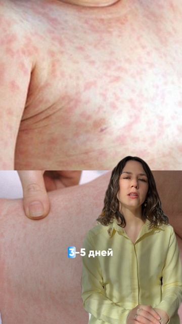 ПРОВЕРЬ СЫПЬ У РЕБЕНКА - как различить сыпь при инфекции