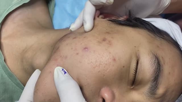 Asmr. Механическое очищение от подкожных угрей.