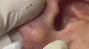 Удаление образования на ухе