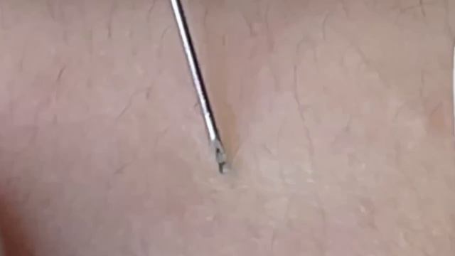 #288 Чистка лица от угрей и акне. Выдавливание прыщей. Удаление черных точек и комедонов