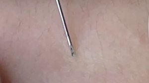 #288 Чистка лица от угрей и акне. Выдавливание прыщей. Удаление черных точек и комедонов