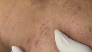 Избавляемся от Acne на лице