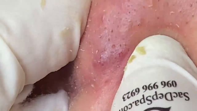 Выдавливание прыщей, угрей, черных точек и камедонов #383