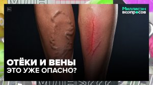 Можно ли вылечить варикоз без операции и когда нужно обращаться к флебологу? | Миллион вопросов