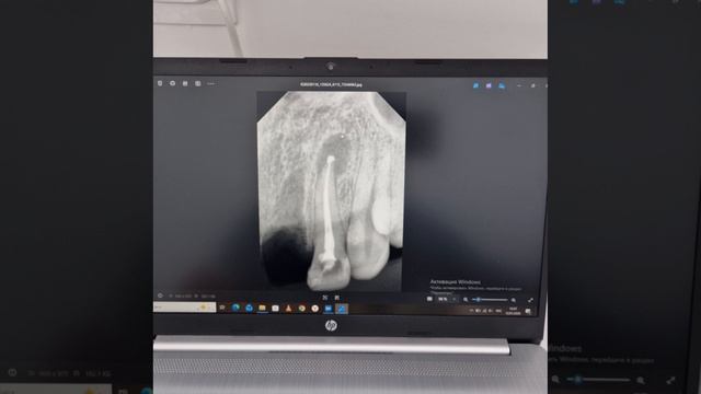 результат лечения воспаленного зуба с контрольным снимком через 6 месяцев.